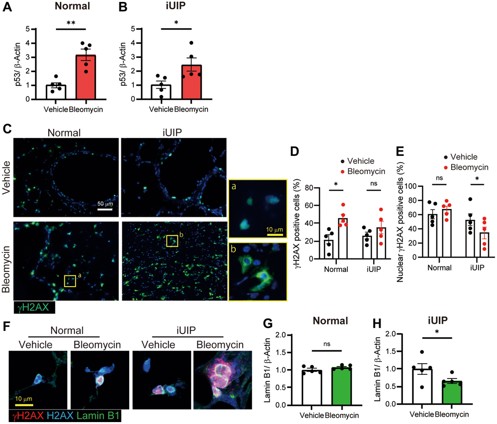 γH2AX expression was observed in the perinuclear region of the iUIP PCLS. (A, B) p53 expression was determined using WB in PCLS from normal (A) and iUIP (B) treated with the vehicle or 1 μΜ bleomycin for 48 h. (C) IF staining for γH2AX in PCLS paraffin-embedded sections from normal and iUIP treated with the vehicle or 1 μM bleomycin for 48 h. (D, E) Percentage of γH2AX-positive cells (D) and nuclear γH2AX-positive cells (E) were calculated based on the total number of cells. (F) IHC staining for(γH2AX (red), H2AX (blue), and lamin B1 (green) in PCLS from normal and iUIP treated with the vehicle or 1 μM bleomycin for 48 h. (G, H) Lamin B1 expression was determined using WB in PCLS from normal (G) and iUIP (H) treated with the vehicle or 1 μM bleomycin for 48 h. β-Actin was used as an internal control for WB. The results are shown as mean ± SE of five mouse PCLSs in each group. Asterisks indicate *P **P 